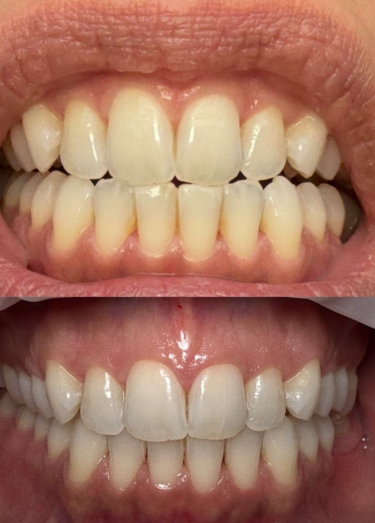 Home Whitening Kit Xpress Smile